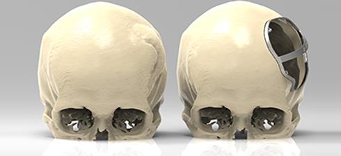 Comparison before and after craniotomy, with a 3D metal cutting guide